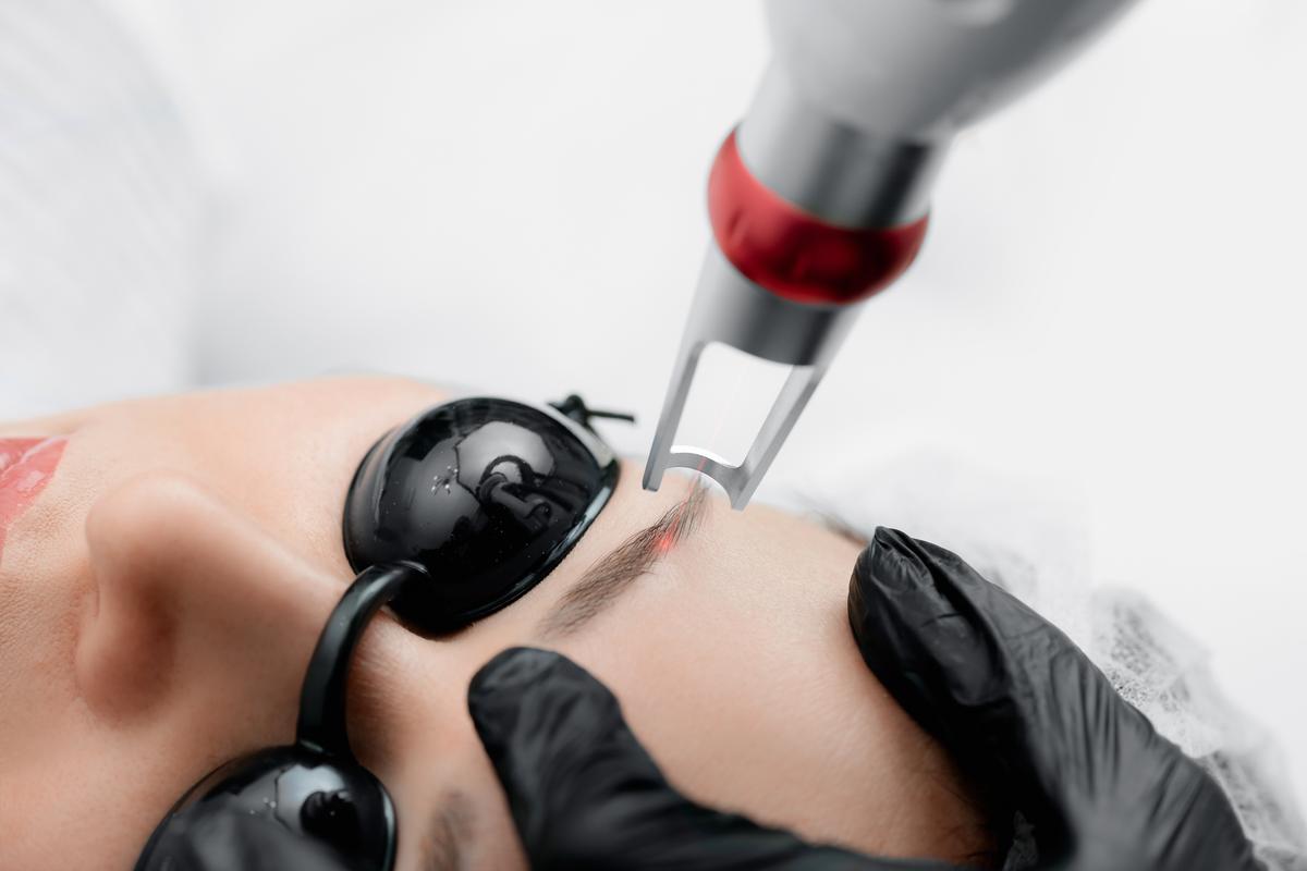Have a Tattoo You Don't Like? What You Need to Know To Get It Removed